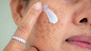 topical creams for pigmented skin