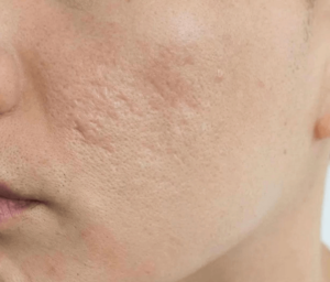avoid-pimple-marks