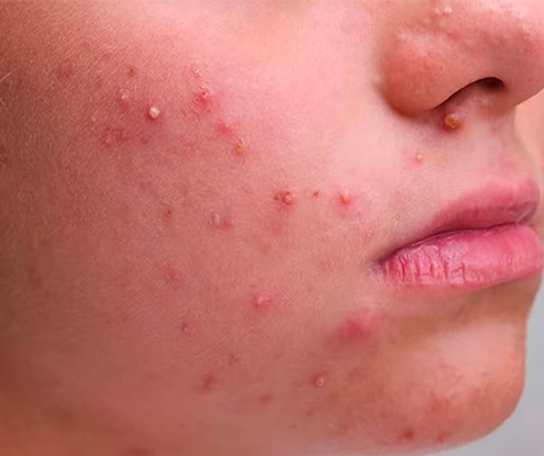 attacking acne